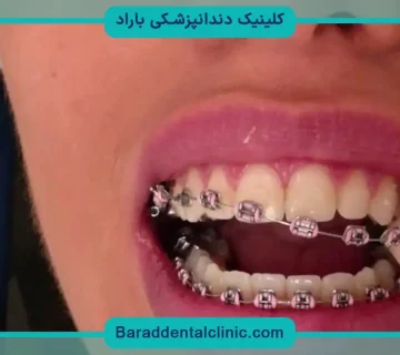 جدا شدن براکت دندان