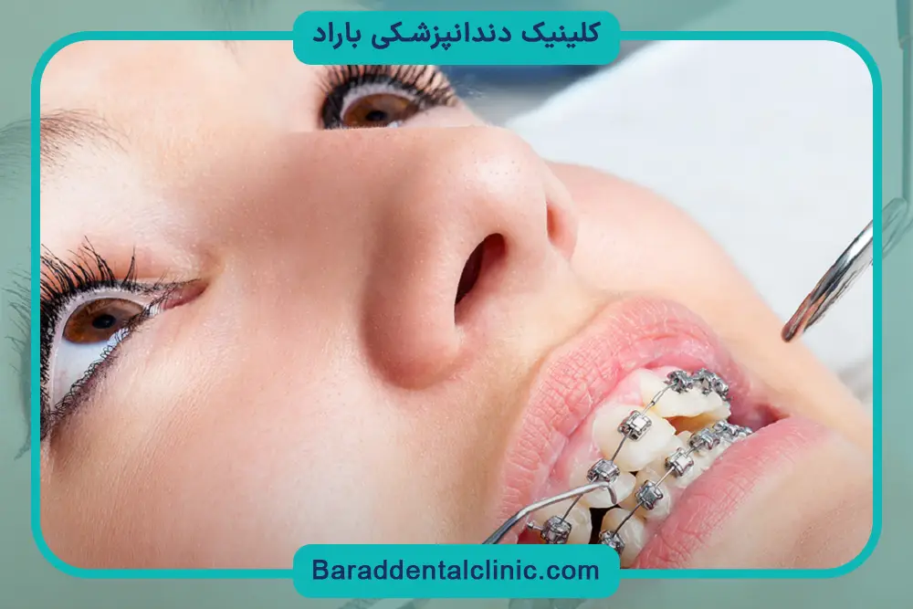 چگونه براکت دندان را نصب کنیم