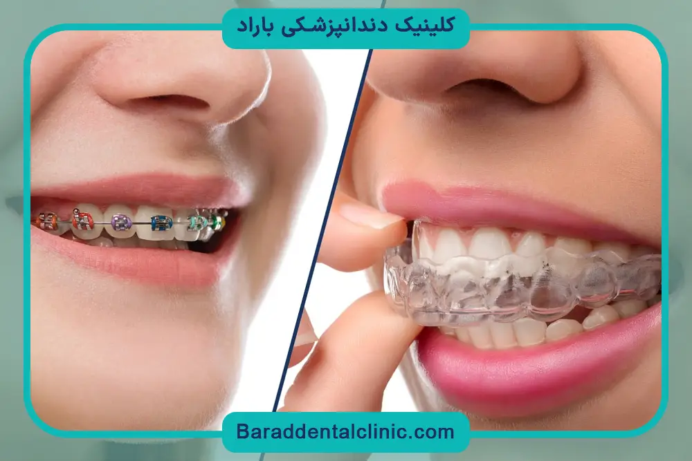 براکت نامرئی دندان