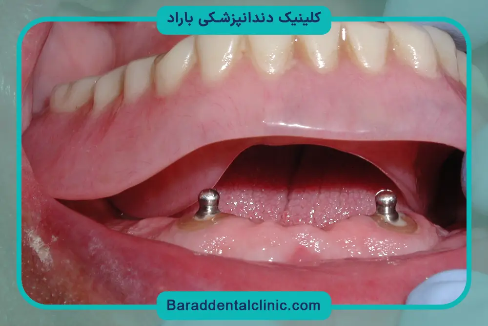 پایه دندان چیست