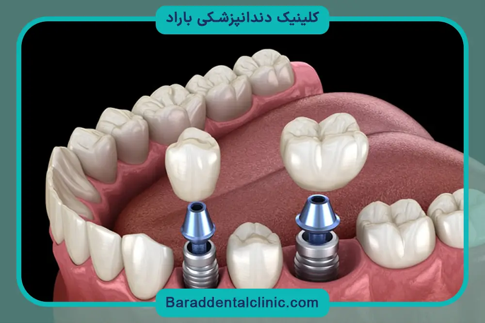 ایمپلنت دندان چگونه است؟ آشنایی کلی