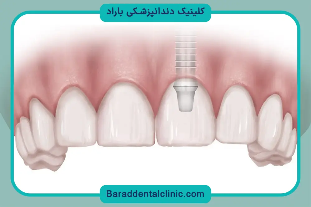 ایمپلنت دندان چیست؟ بررسی عملکرد
