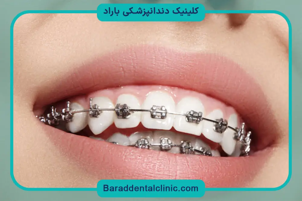 دلایل جدا شدن براکت دندان