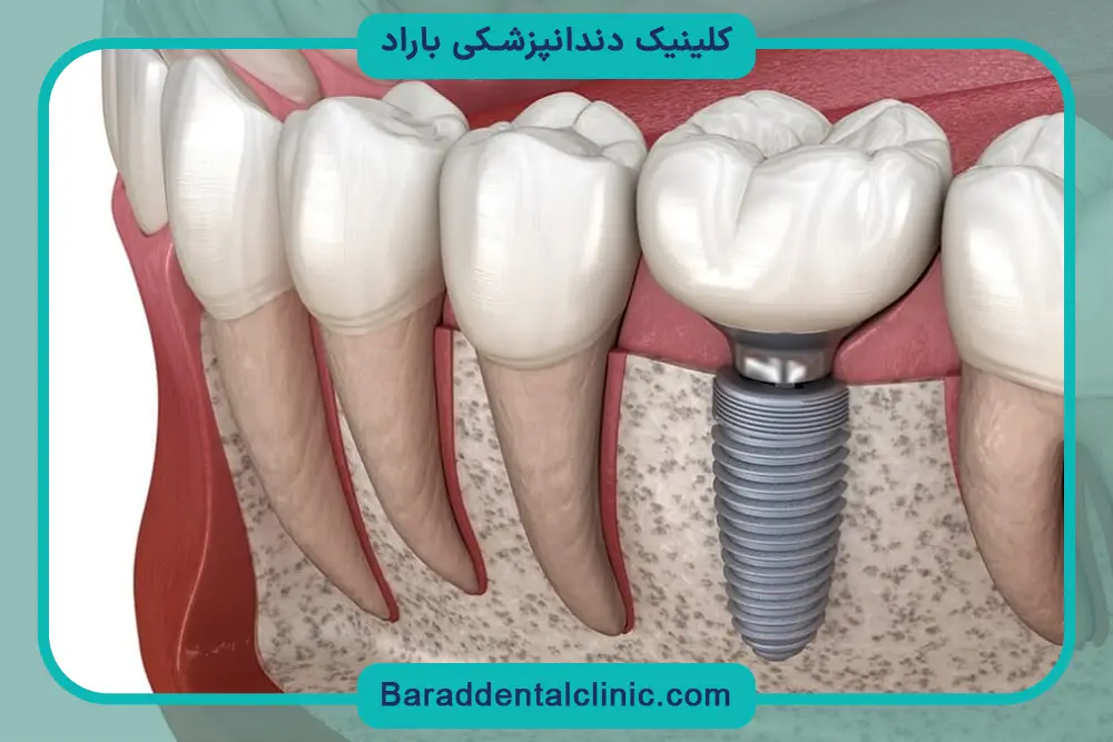 آیا واقعا ایمپلنت دندان درد دارد؟