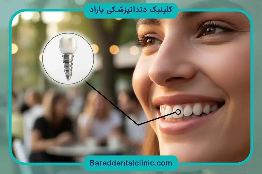 ایمپلنت دندان جلو چیست؟