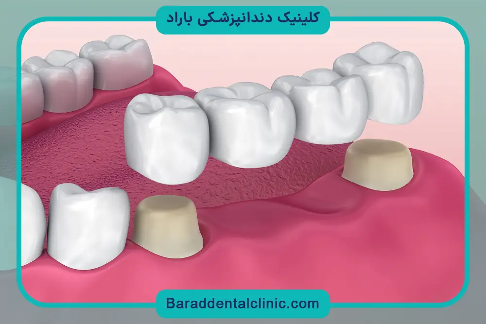 پایه دندان مصنوعی چیست؟