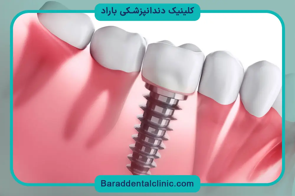 مشاوره اولیه، اولین مراحل ایمپلنت دندان