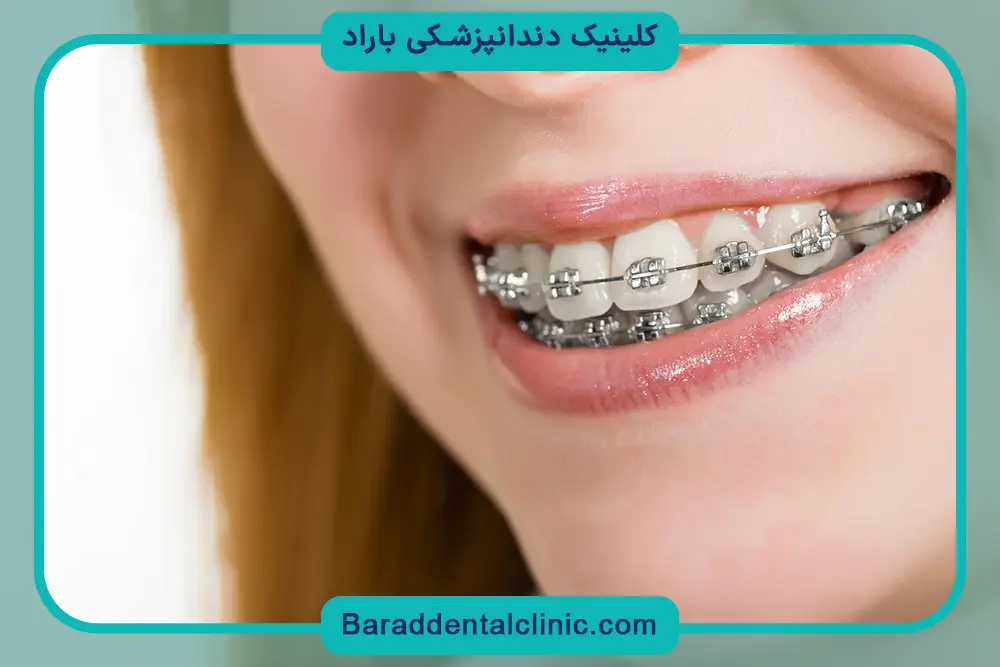 براکت فلزی دندان چیست؟