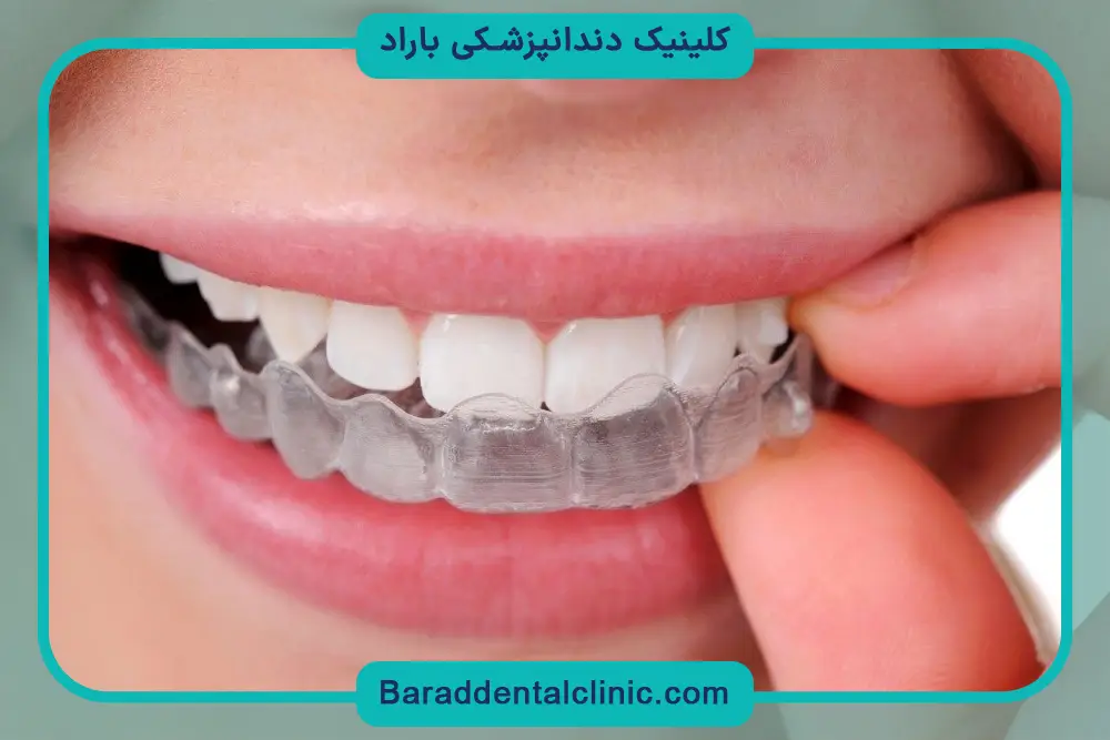 نحوه عملکرد براکت نامرئی دندان 