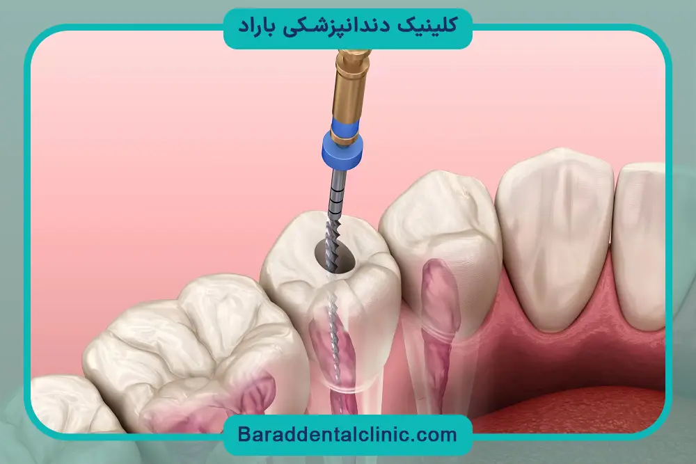 اهمیت پایه دندان برای عصب کشی 