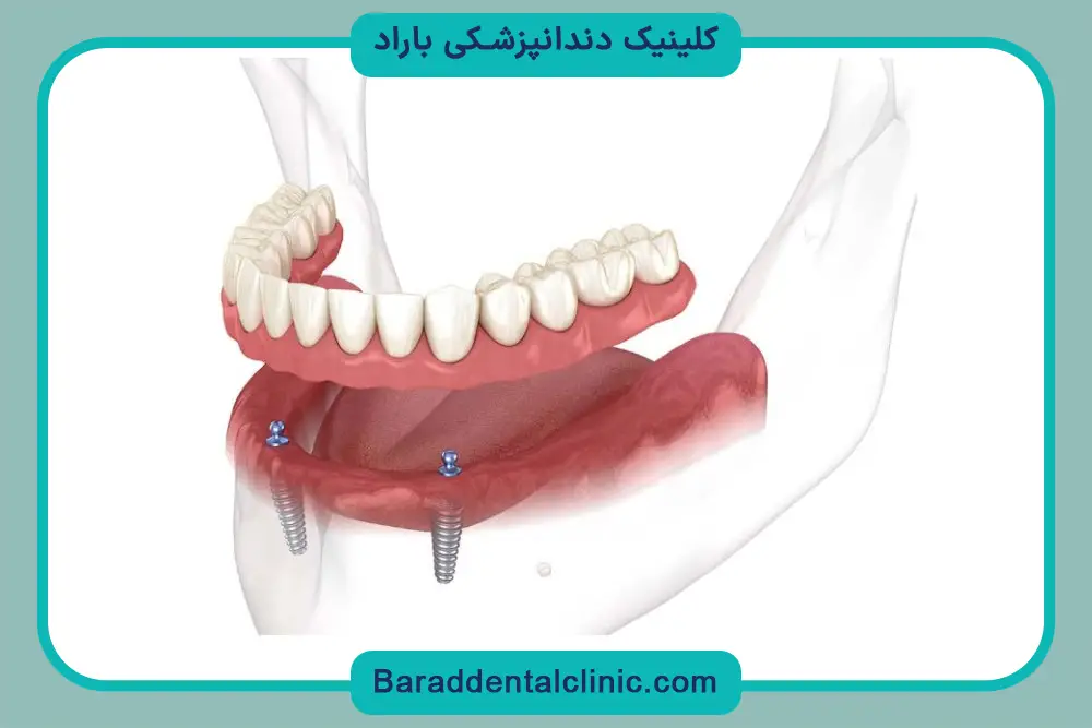 آشنایی با پایه دندان روکش