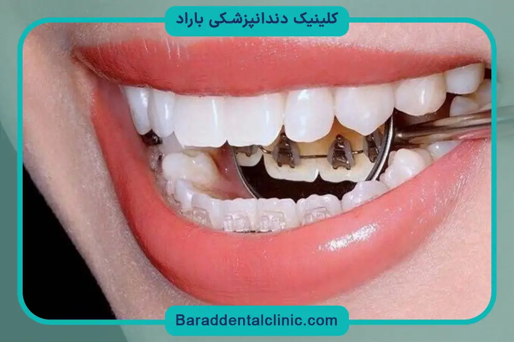 براکت ارتودنسی پشت دندان چیست؟