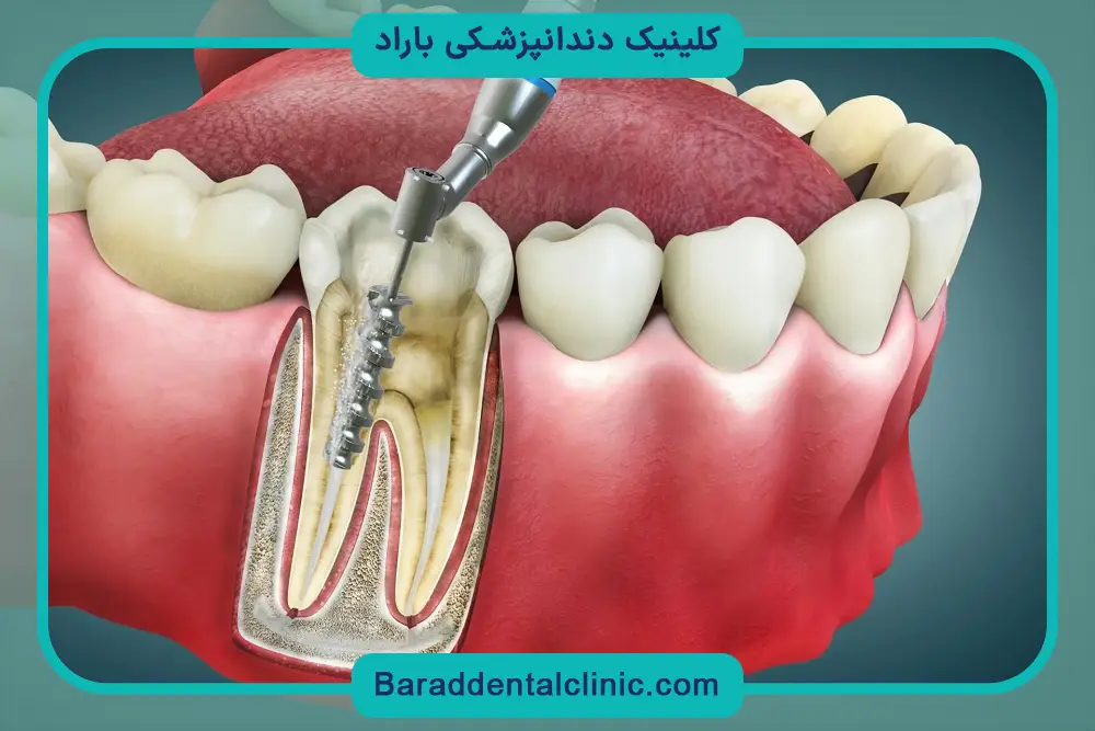 کاشت پایه دندان چیست؟