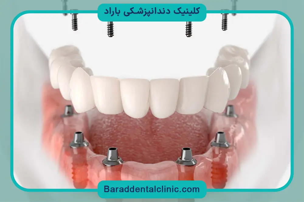 پایه دندان چیست؟ آشنایی کلی