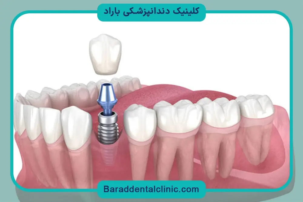 ایمپلنت دندان چگونه است؟ بررسی مراحل