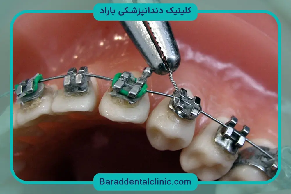 اقدامات بعد از جدا شدن براکت دندان