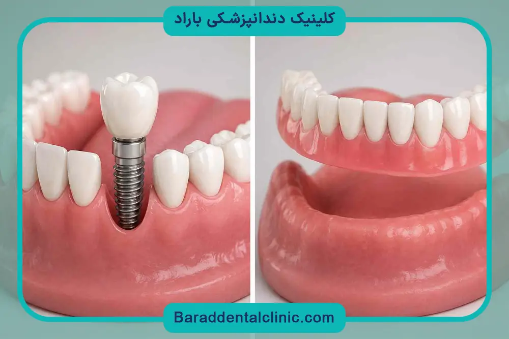 مراحل ایمپلنت دندان جلو 