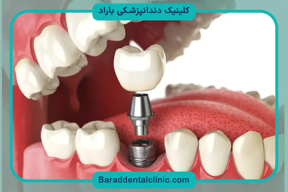 مراحل جراحی ایمپلنت دندان 