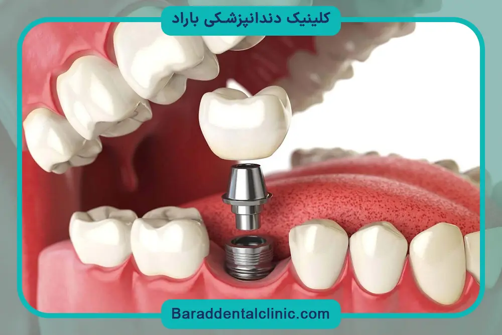 فرایند ایجاد حفره در فیلم ایمپلنت دندان 