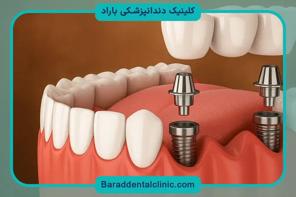 قیمت ایمپلنت دیجیتال چقدر است؟ بررسی عوامل