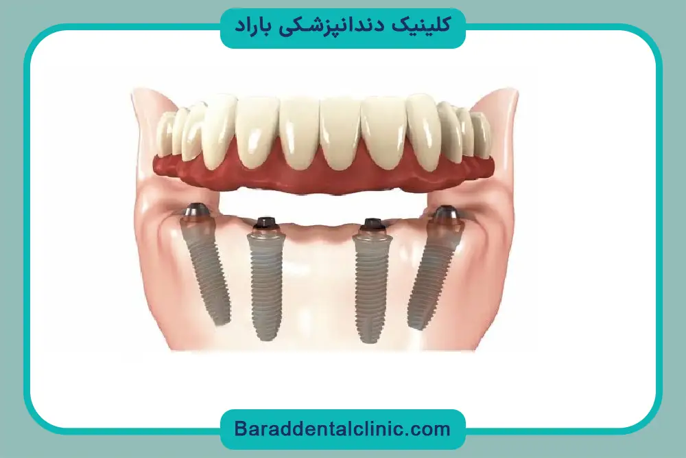 انواع پایه دندان روکش