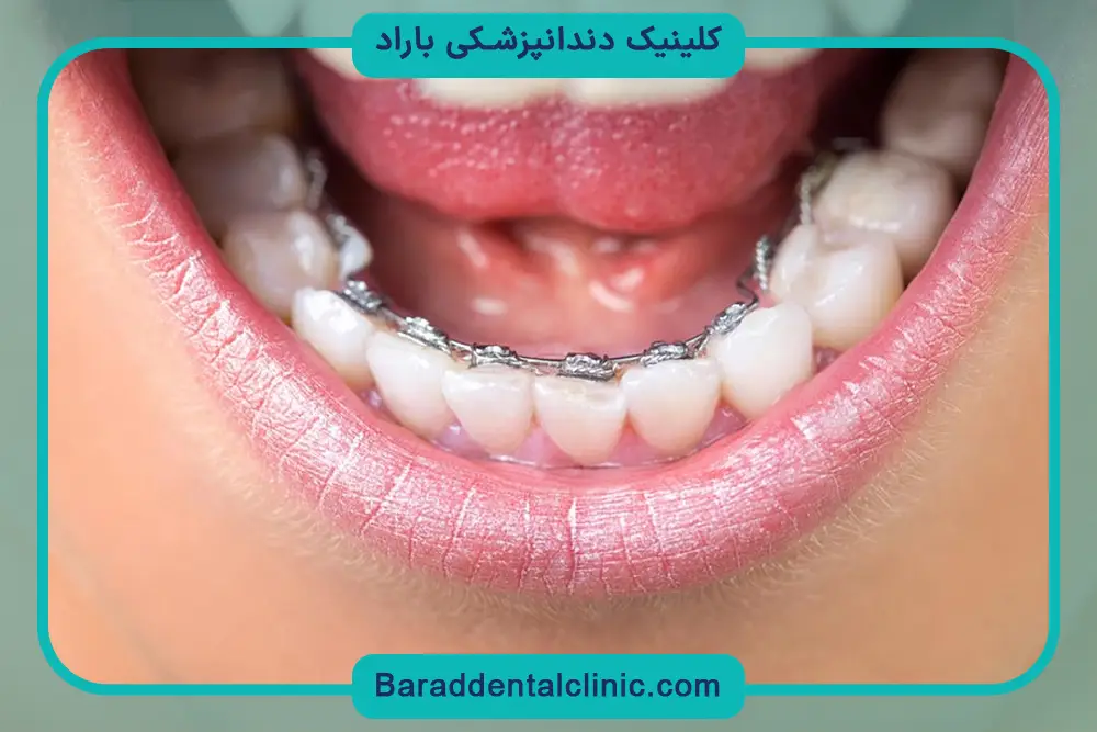 مزایای براکت ارتودنسی پشت دندان 