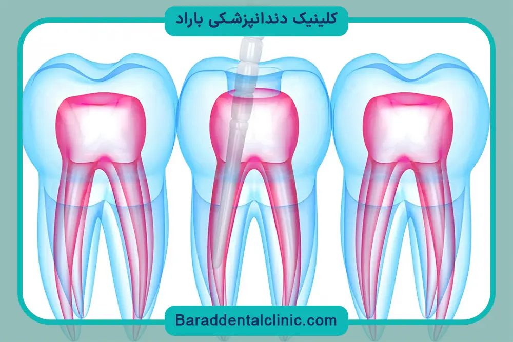 مراحل کاشت پایه دندان