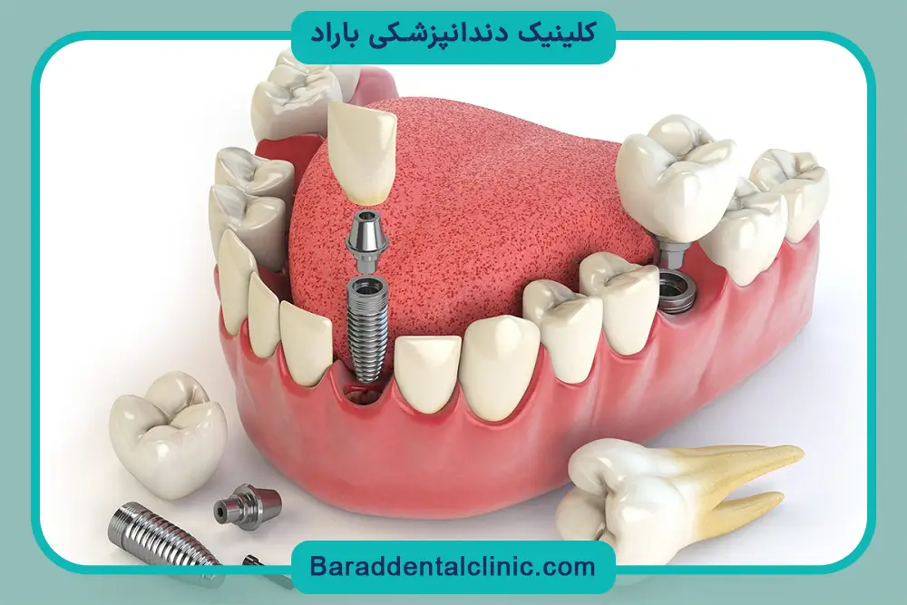 مراقبت‌های ایمپلنت دندان چگونه است