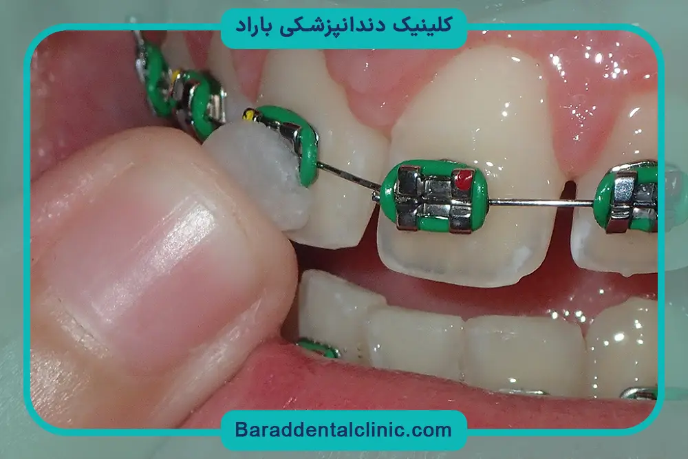 مشکلات جدا شدن براکت دندان