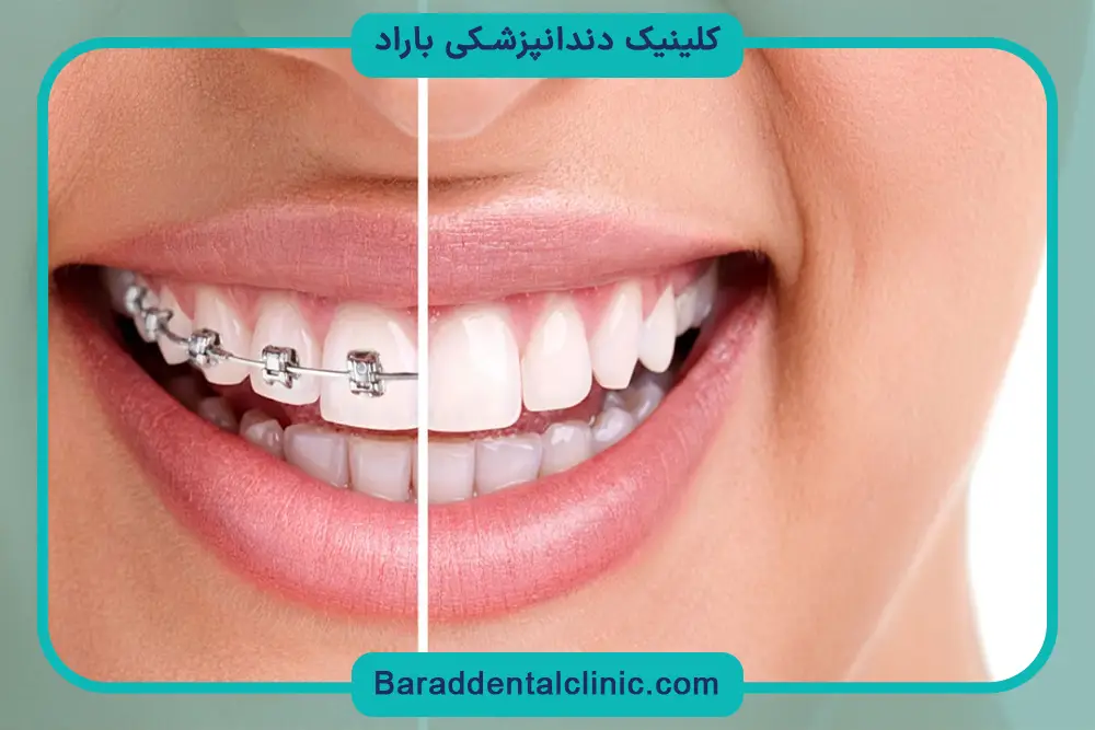 چگونه براکت دندان را نصب کنیم؟ رد کردن سیم ارتودنسی