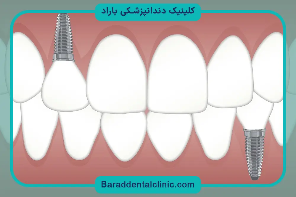 مراقبت‌های بعد از ایمپلنت دندان جلو 