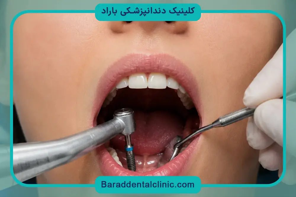 تغذیه بعد از جراحی ایمپلنت دندان 
