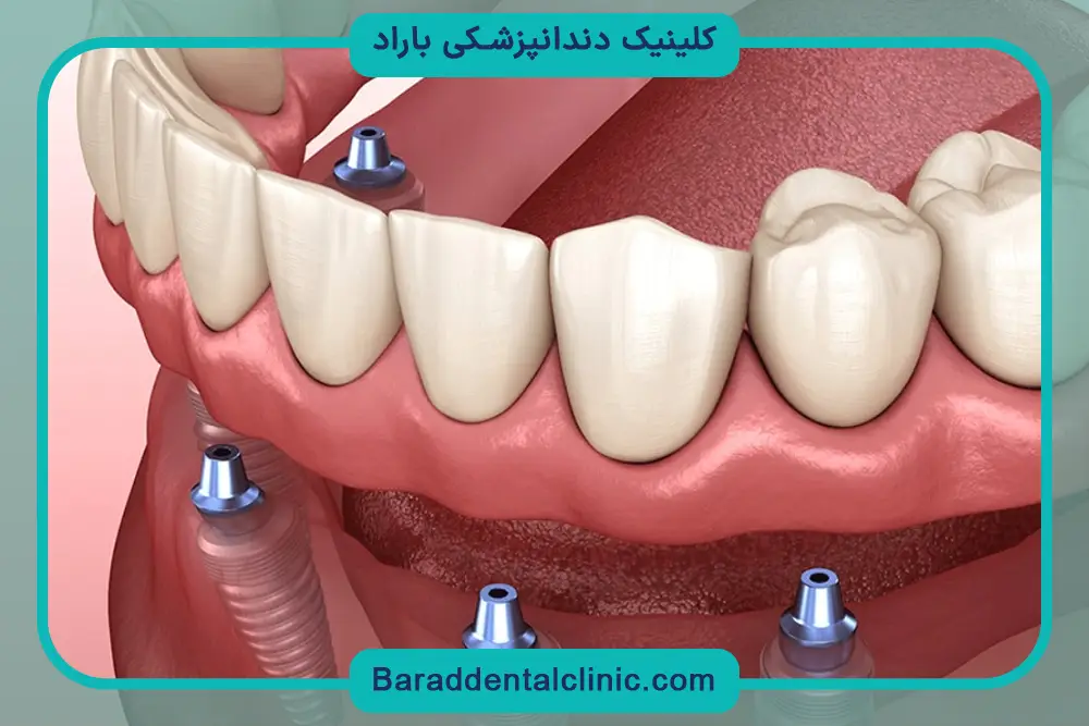 شرایط ایمپلنت دیجیتال اقساطی