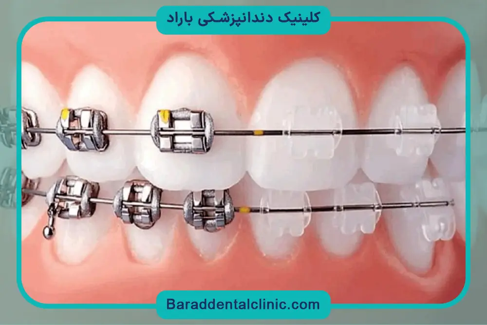 کاندیدای مناسب براکت نامرئی دندان 