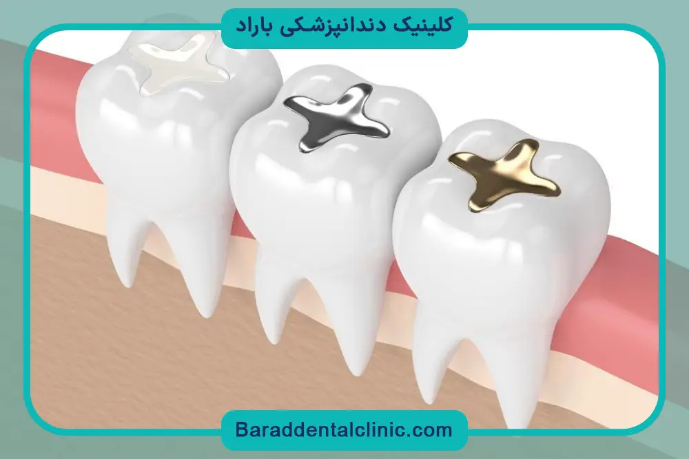 مراحل نصب پایه دندان برای عصب کشی 