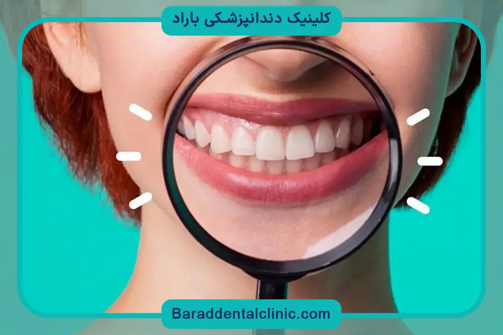 مزایای پایه دندان روکش