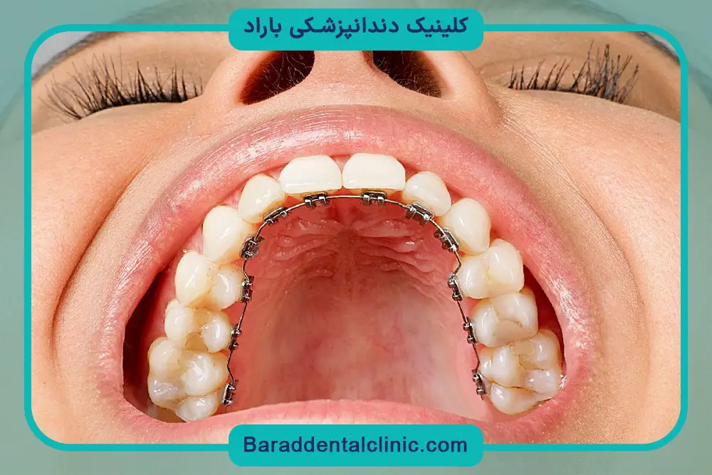 مراقبت‌های بعد از براکت ارتودنسی پشت دندان 