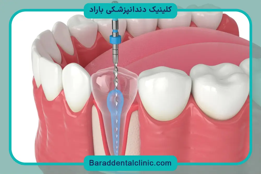 مراقبتهای بعد از کاشت پایه دندان