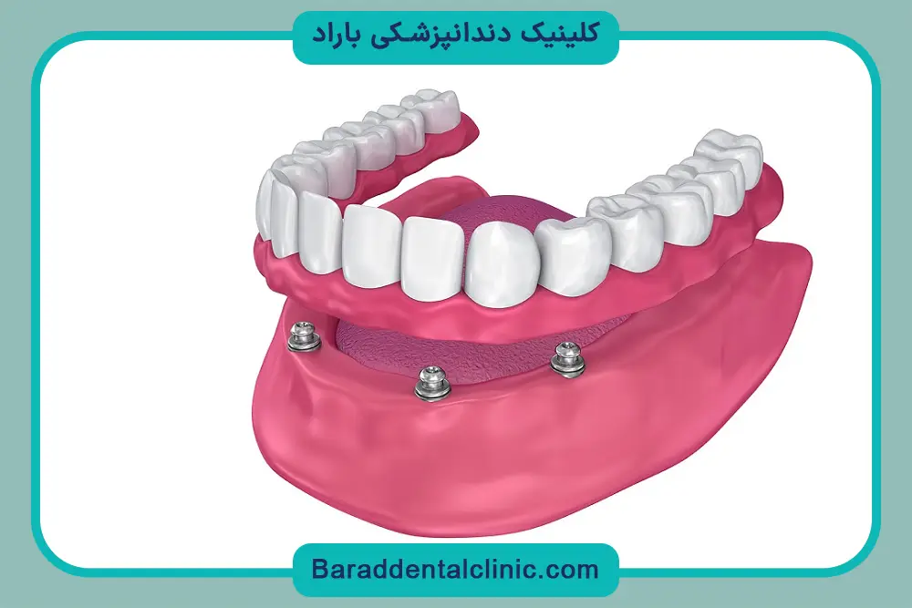 مزایای پایه دندان چیست؟