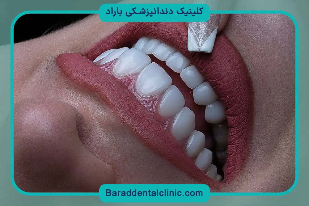 بهترین مارک کامپوزیت ونیر دندان