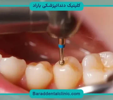 هزینه بازسازی دندان