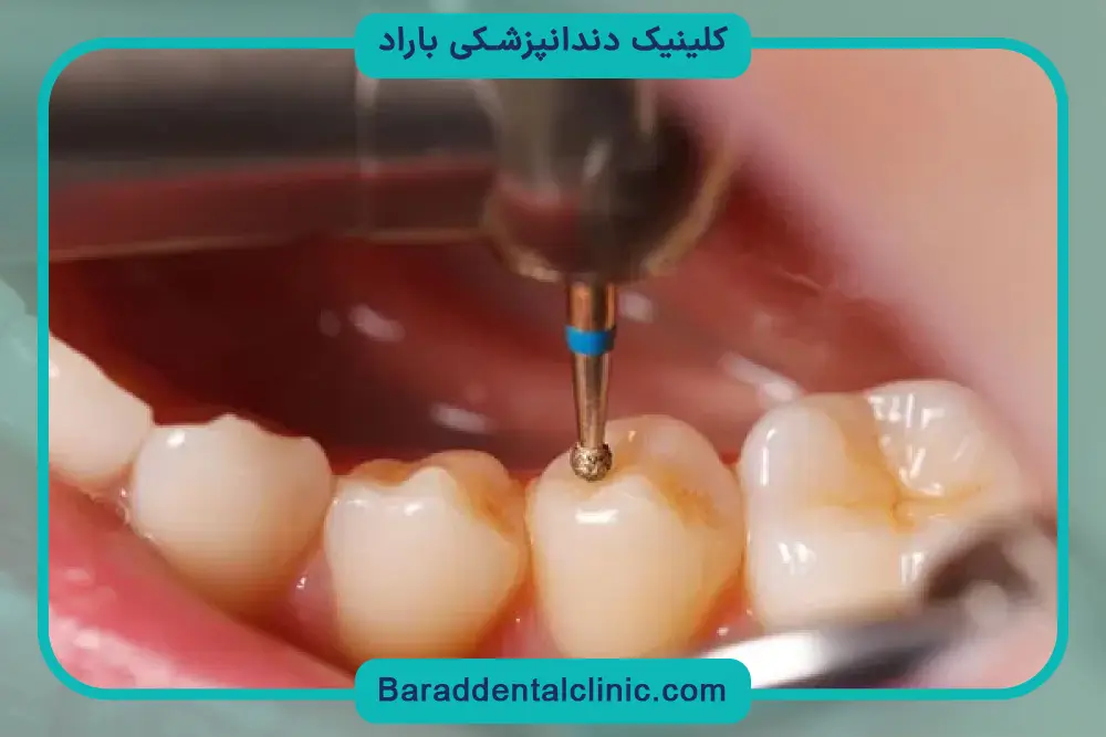 هزینه بازسازی دندان
