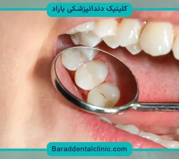انواع بازسازی دندان