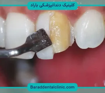 ترمیم و بازسازی دندان