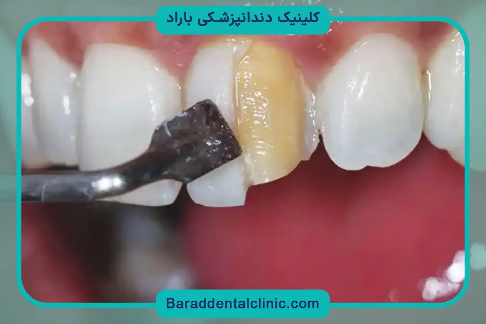 ترمیم و بازسازی دندان
