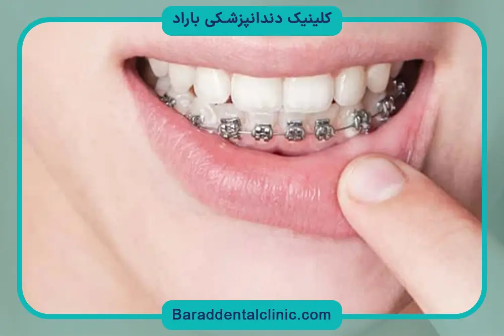 قیمت سیم کشی دندان فک پایین