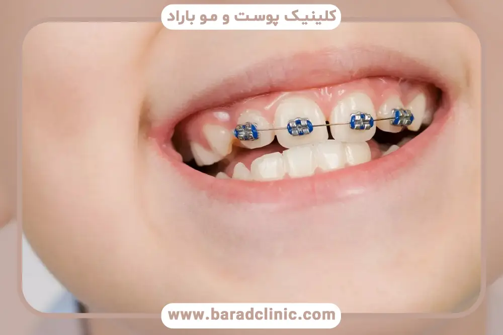 سیم کشی دندان تا چه سنی است