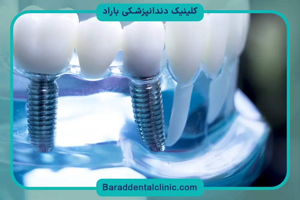 خدمات ایمپلنت دیجیتال پاسداران 