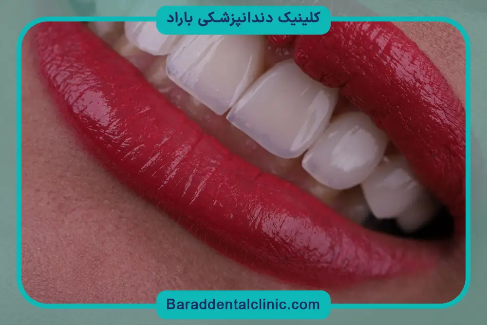 دلایل انجام کامپوزیت تهران