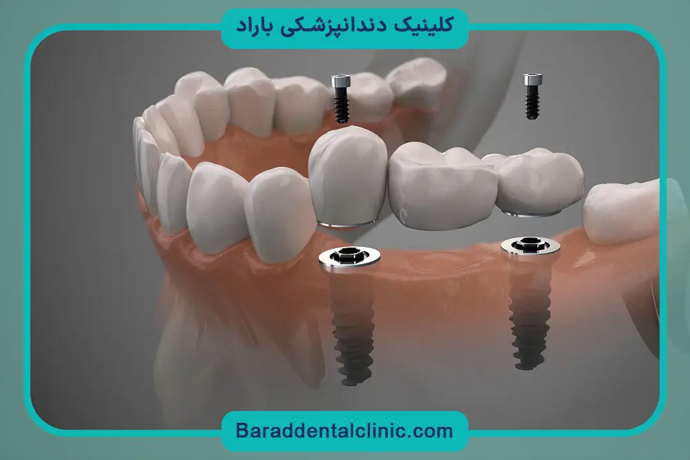 آشنایی با ایمپلنت دیجیتال